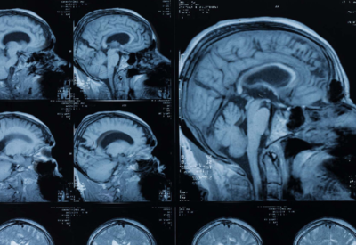 Kopf MRT zur Entdeckung von Hirnthrombosen